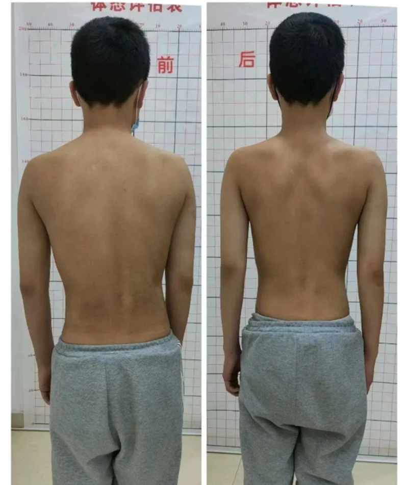 孩子含胸、高低肩？5-18歲暑期脊柱矯正營(yíng)來救場(chǎng)！_01.png